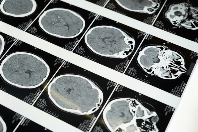 Magnesium L-Threonate: A Brain-Boosting Supplement